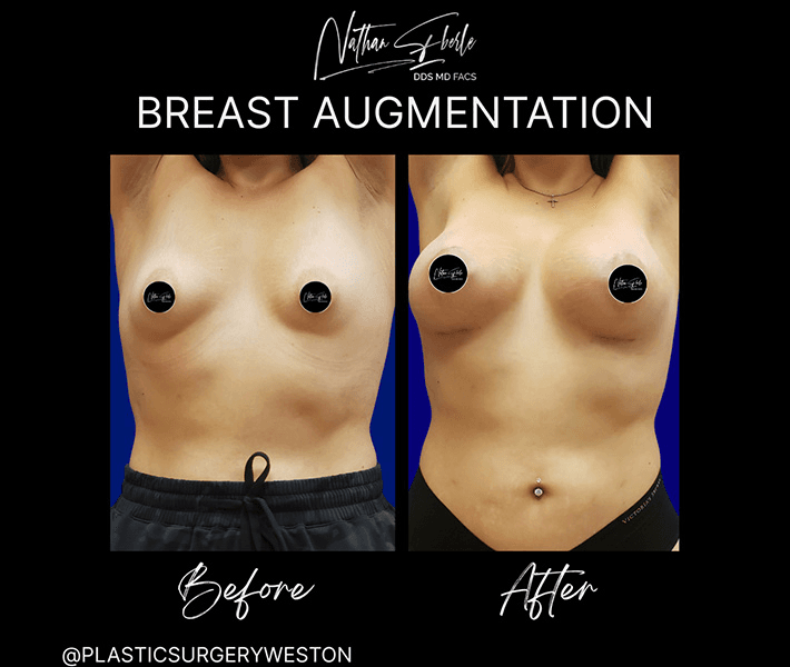 Breast Augmentation before and after case 130, actual patient at Weston Center for Plastic Surgery