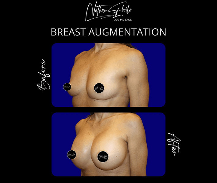 Breast Augmentation before and after case 133, actual patient at Weston Center for Plastic Surgery