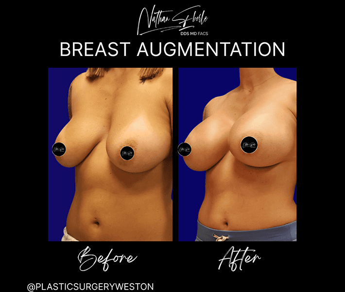 Breast Augmentation before and after case 138, actual patient at Weston Center for Plastic Surgery