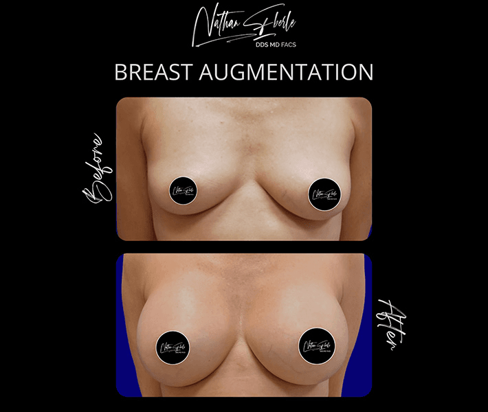 Breast Augmentation before and after case 151, actual patient at Weston Center for Plastic Surgery
