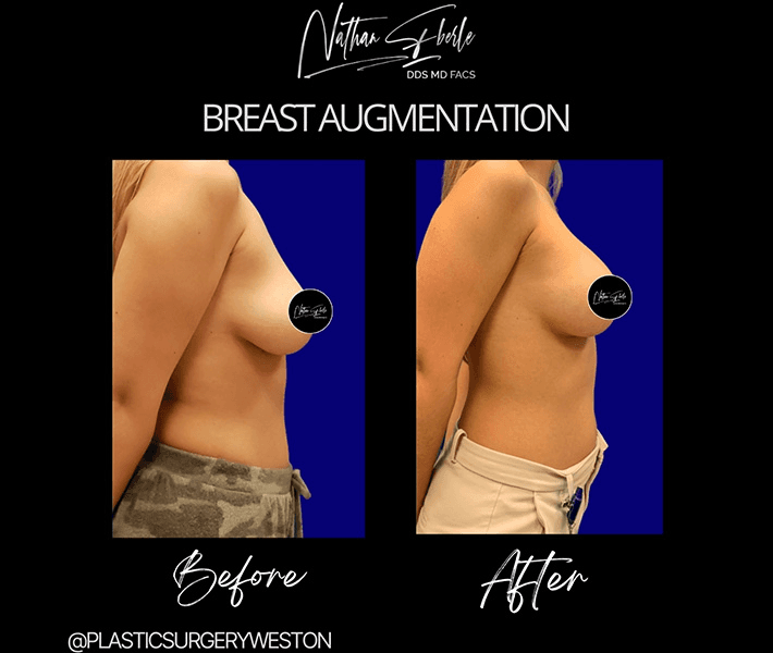 Breast Augmentation before and after case 152, actual patient at Weston Center for Plastic Surgery