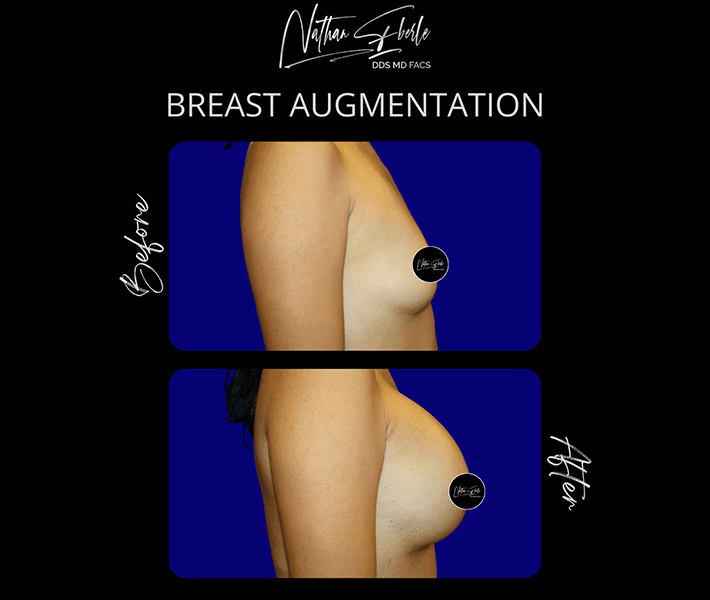 Breast Augmentation before and after case 153, actual patient at Weston Center for Plastic Surgery