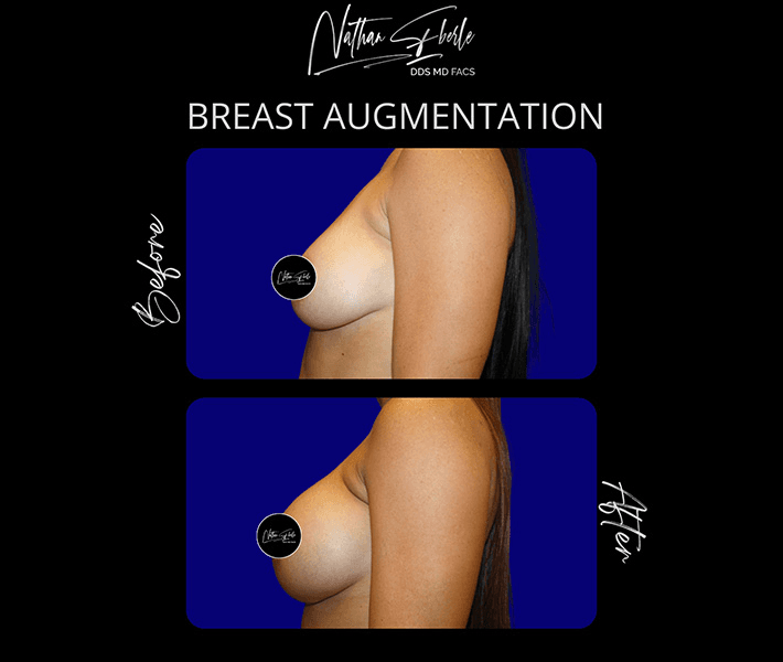 Breast Augmentation before and after case 154, actual patient at Weston Center for Plastic Surgery