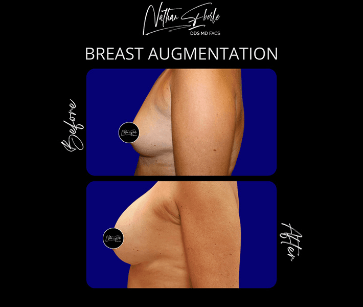 Breast Augmentation before and after case 155, actual patient at Weston Center for Plastic Surgery