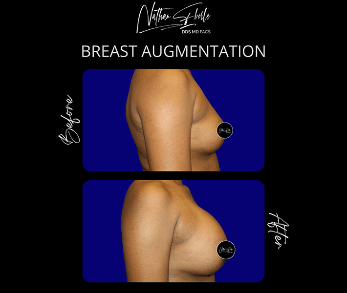 Breast Augmentation before and after case 156, actual patient at Weston Center for Plastic Surgery