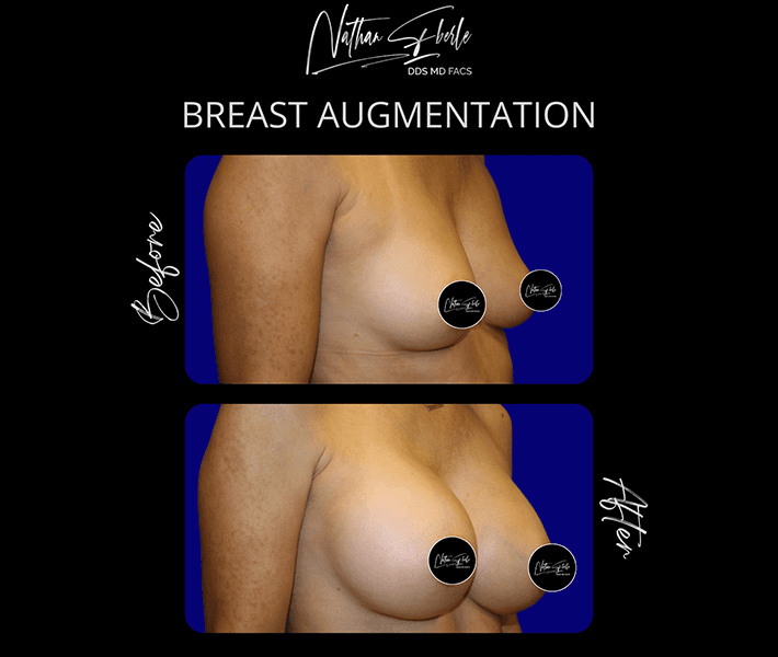 Breast Augmentation before and after case 157, actual patient at Weston Center for Plastic Surgery