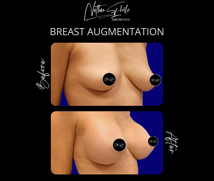 Breast Augmentation before and after case 159, actual patient at Weston Center for Plastic Surgery