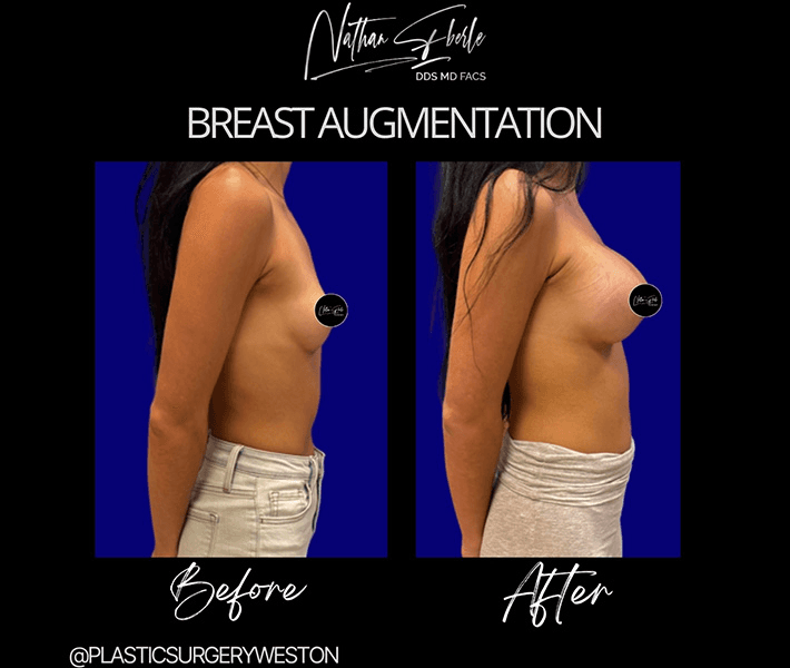Breast Augmentation before and after case 161, actual patient at Weston Center for Plastic Surgery