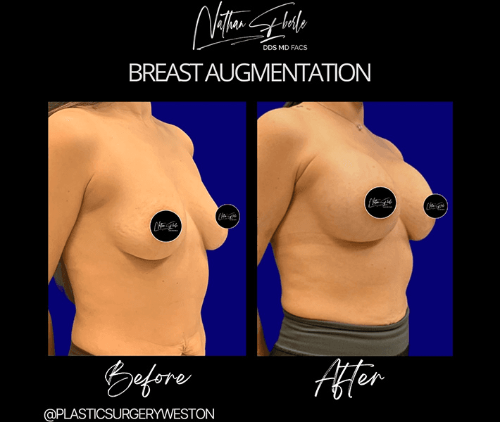 Breast Augmentation before and after case 162, actual patient at Weston Center for Plastic Surgery