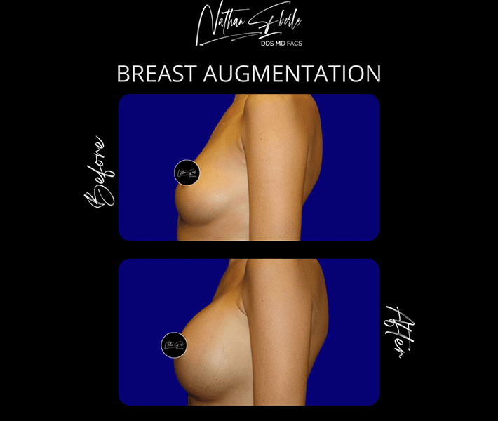 Breast Augmentation before and after case 167, actual patient at Weston Center for Plastic Surgery