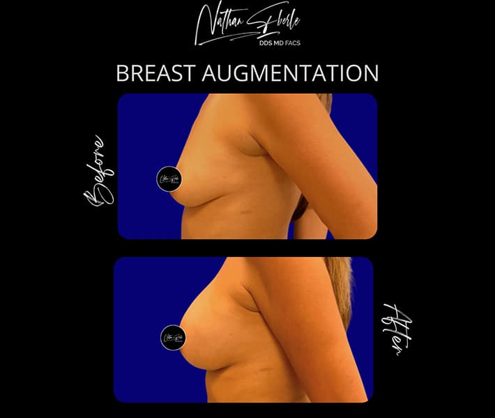 Breast Augmentation before and after case 171, actual patient at Weston Center for Plastic Surgery