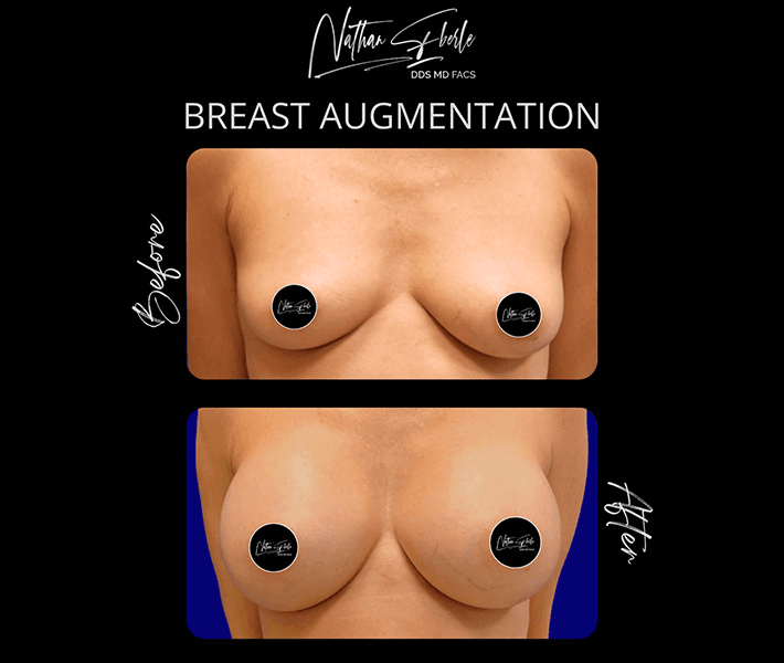 Breast Augmentation before and after case 172, actual patient at Weston Center for Plastic Surgery