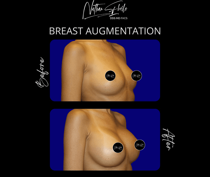 Breast Augmentation before and after case 174, actual patient at Weston Center for Plastic Surgery