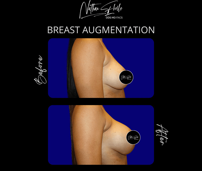 Breast Augmentation before and after case 180, actual patient at Weston Center for Plastic Surgery