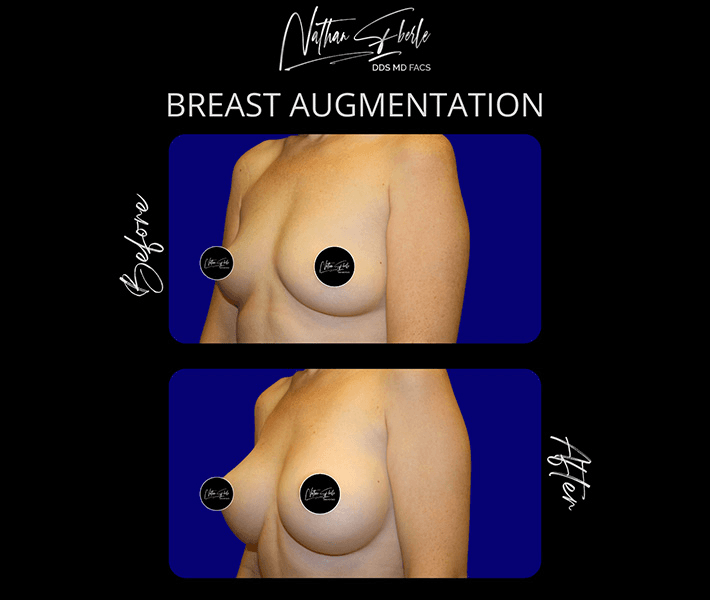 Breast Augmentation before and after case 182, actual patient at Weston Center for Plastic Surgery