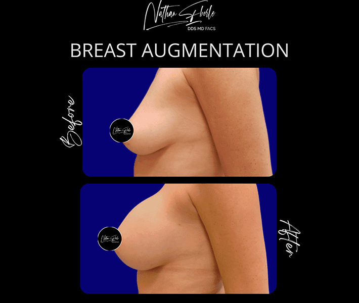 Breast Augmentation before and after case 185, actual patient at Weston Center for Plastic Surgery