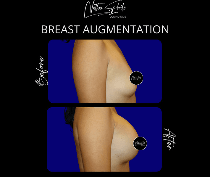 Breast Augmentation before and after case 186, actual patient at Weston Center for Plastic Surgery