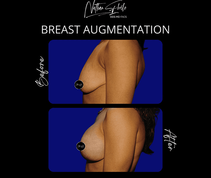 Breast Augmentation before and after case 187, actual patient at Weston Center for Plastic Surgery