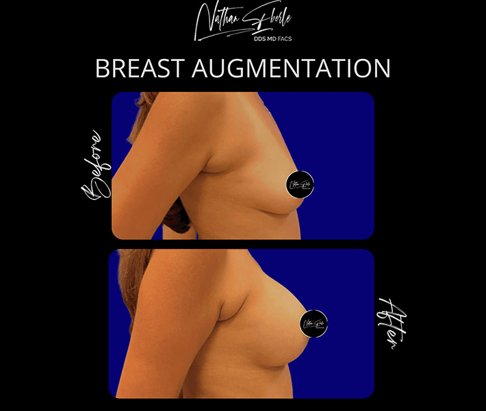 Breast Augmentation before and after case 189, actual patient at Weston Center for Plastic Surgery