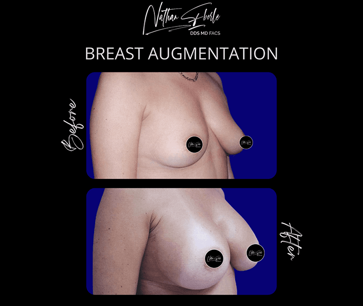 Breast Augmentation before and after case 19, actual patient at Weston Center for Plastic Surgery