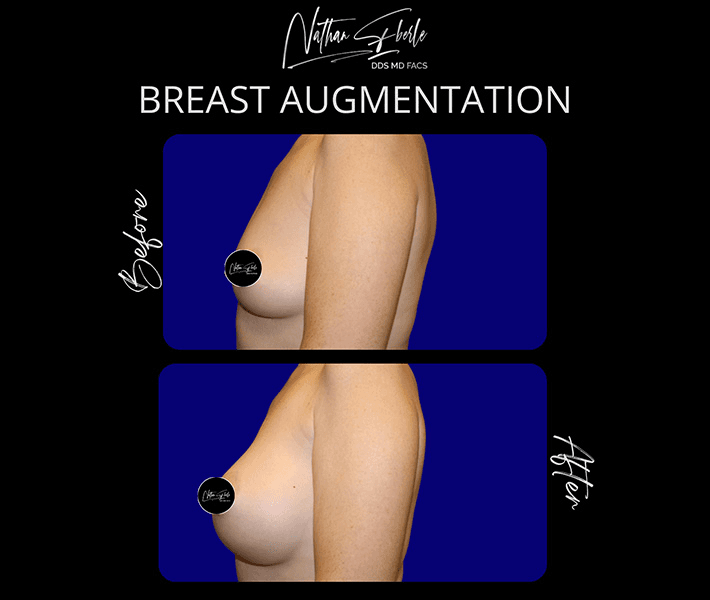 Breast Augmentation before and after case 190, actual patient at Weston Center for Plastic Surgery