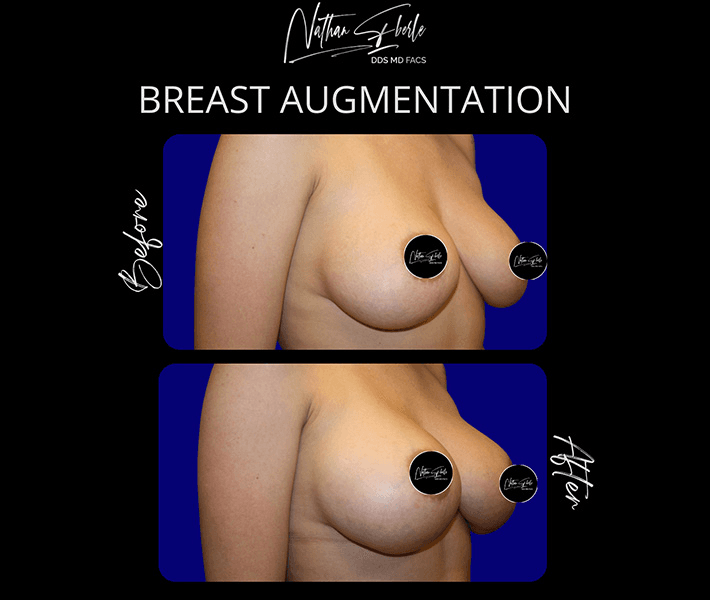 Breast Augmentation before and after case 192, actual patient at Weston Center for Plastic Surgery