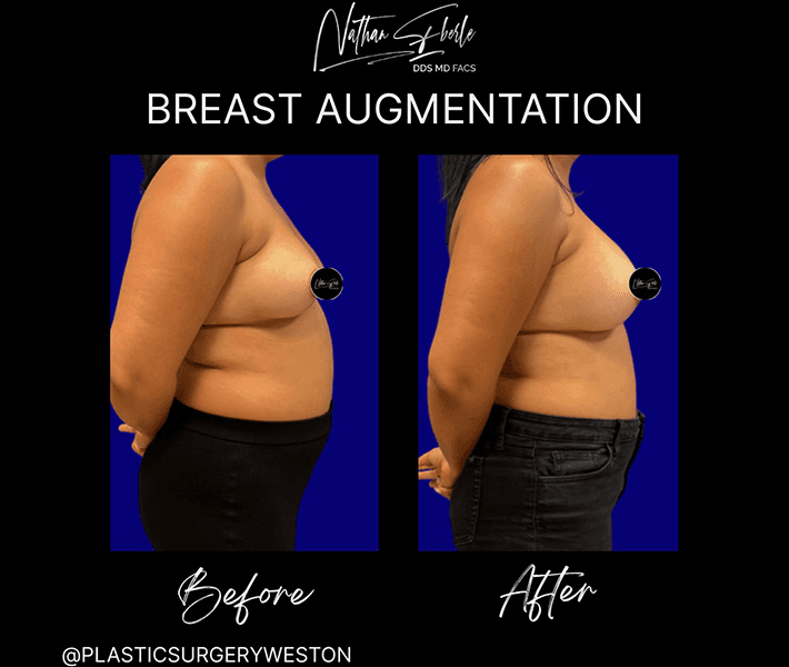 Breast Augmentation before and after case 193, actual patient at Weston Center for Plastic Surgery