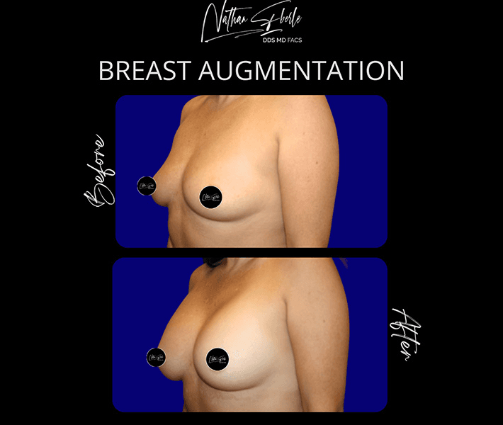 Breast Augmentation before and after case 195, actual patient at Weston Center for Plastic Surgery