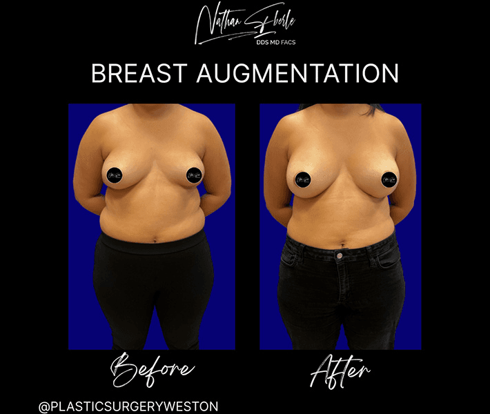 Breast Augmentation before and after case 196, actual patient at Weston Center for Plastic Surgery