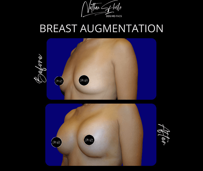 Breast Augmentation before and after case 197, actual patient at Weston Center for Plastic Surgery