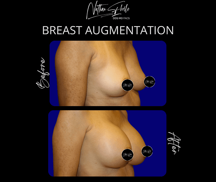 Breast Augmentation before and after case 199, actual patient at Weston Center for Plastic Surgery