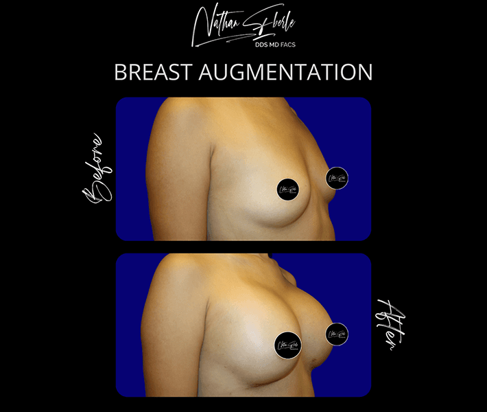 Breast Augmentation before and after case 2, actual patient at Weston Center for Plastic Surgery