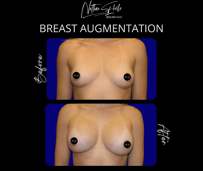 Breast Augmentation before and after case 200, actual patient at Weston Center for Plastic Surgery