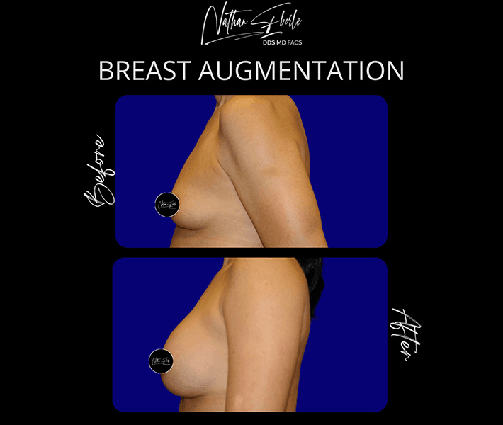 Breast Augmentation before and after case 201, actual patient at Weston Center for Plastic Surgery