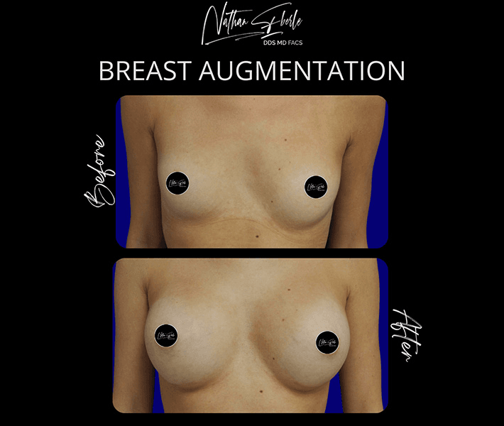Breast Augmentation before and after case 202, actual patient at Weston Center for Plastic Surgery