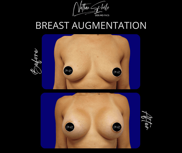 Breast Augmentation before and after case 204, actual patient at Weston Center for Plastic Surgery