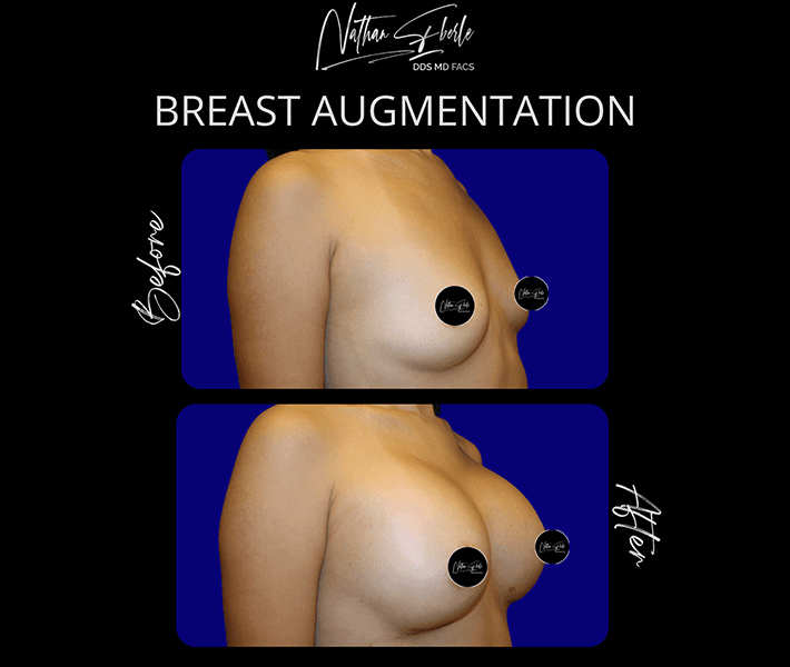 Breast Augmentation before and after case 207, actual patient at Weston Center for Plastic Surgery