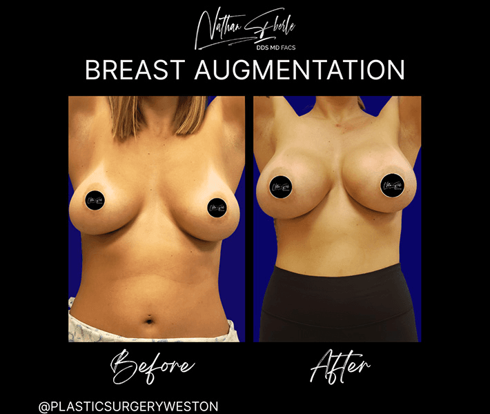 Breast Augmentation before and after case 209, actual patient at Weston Center for Plastic Surgery