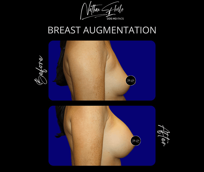 Breast Augmentation before and after case 210, actual patient at Weston Center for Plastic Surgery