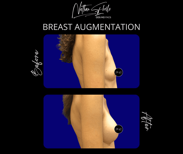 Breast Augmentation before and after case 215, actual patient at Weston Center for Plastic Surgery