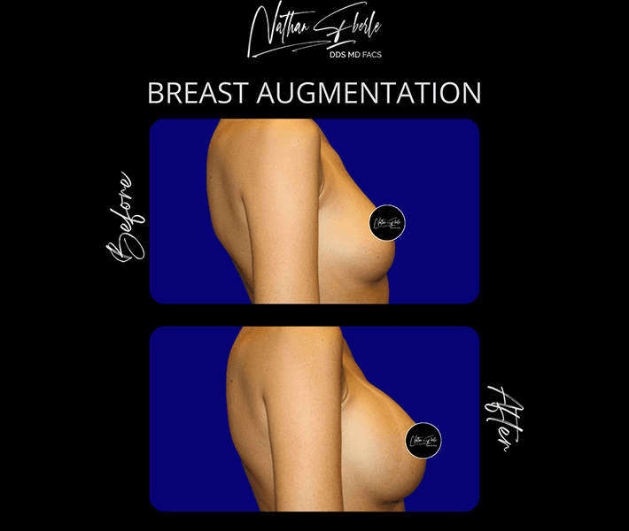 Breast Augmentation before and after case 216, actual patient at Weston Center for Plastic Surgery