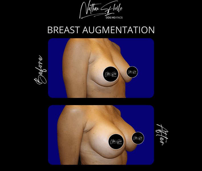 Breast Augmentation before and after case 217, actual patient at Weston Center for Plastic Surgery