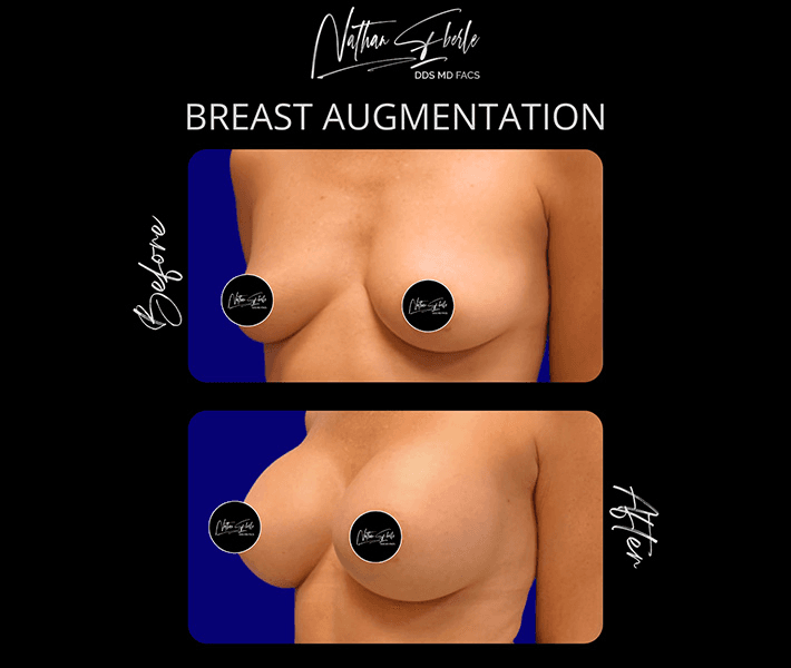 Breast Augmentation before and after case 218, actual patient at Weston Center for Plastic Surgery