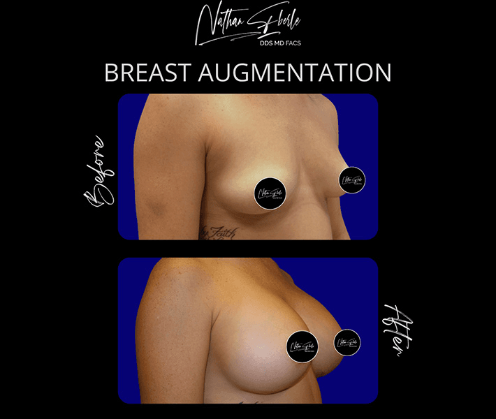 Breast Augmentation before and after case 219, actual patient at Weston Center for Plastic Surgery