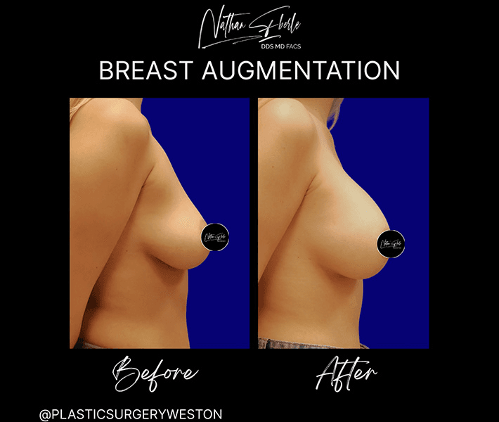 Breast Augmentation before and after case 226, actual patient at Weston Center for Plastic Surgery