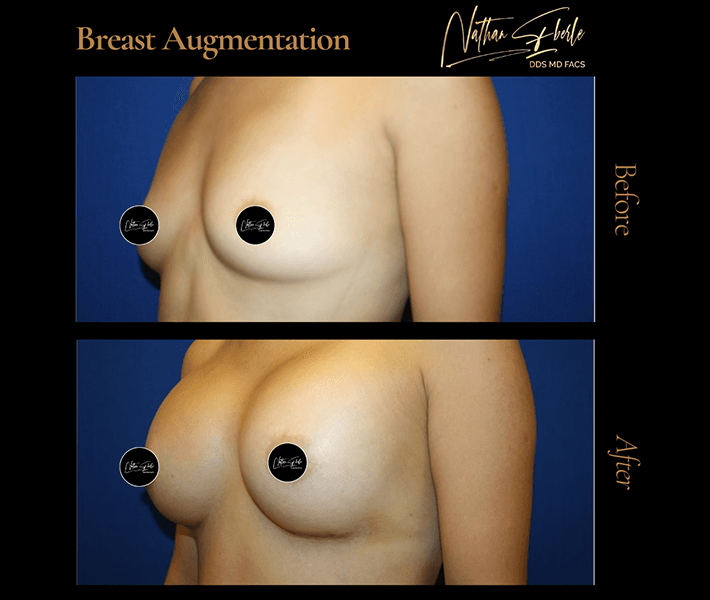 Breast Augmentation before and after case 23, actual patient at Weston Center for Plastic Surgery