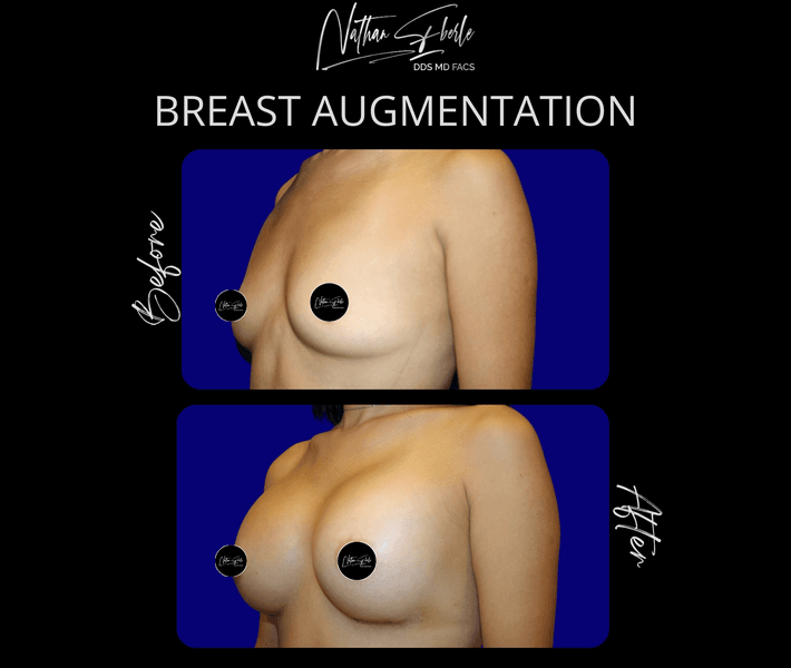Breast Augmentation before and after case 23