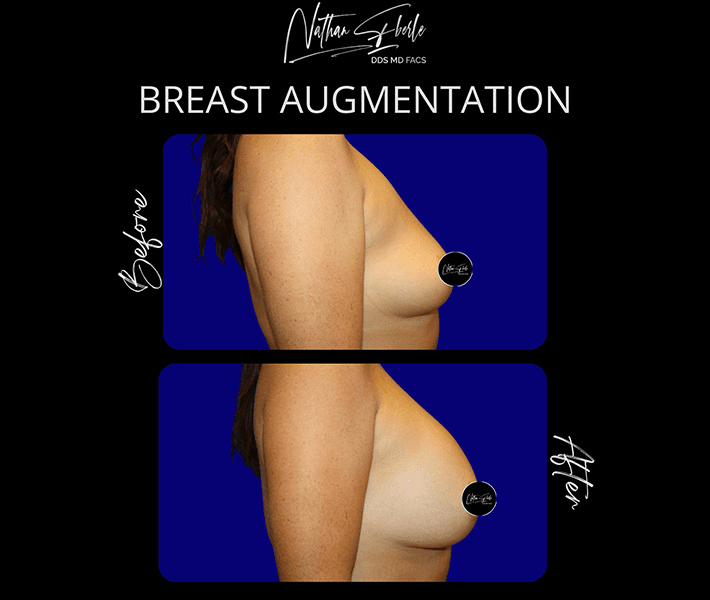 Breast Augmentation before and after case 230, actual patient at Weston Center for Plastic Surgery