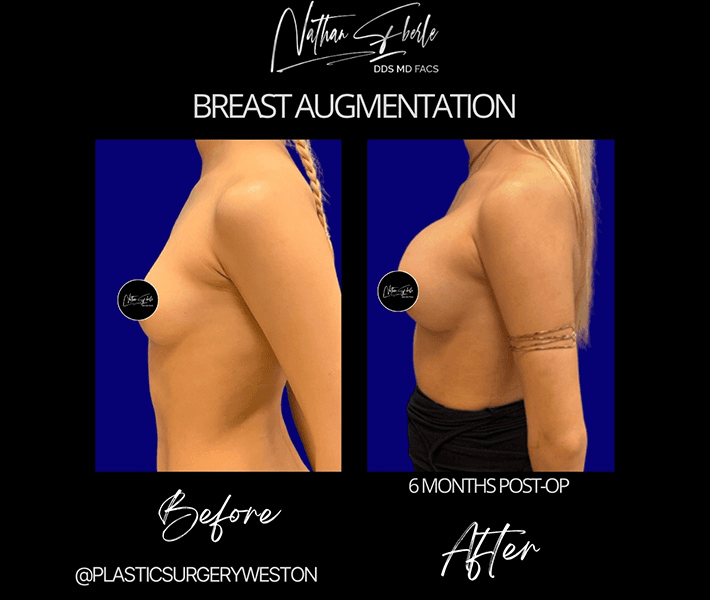 Breast Augmentation before and after case 236, actual patient at Weston Center for Plastic Surgery
