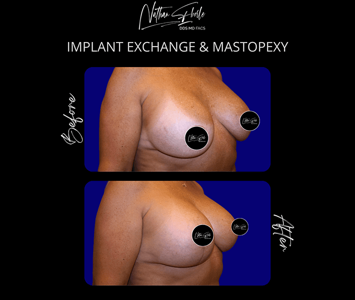 Breast Augmentation before and after case 24, actual patient at Weston Center for Plastic Surgery